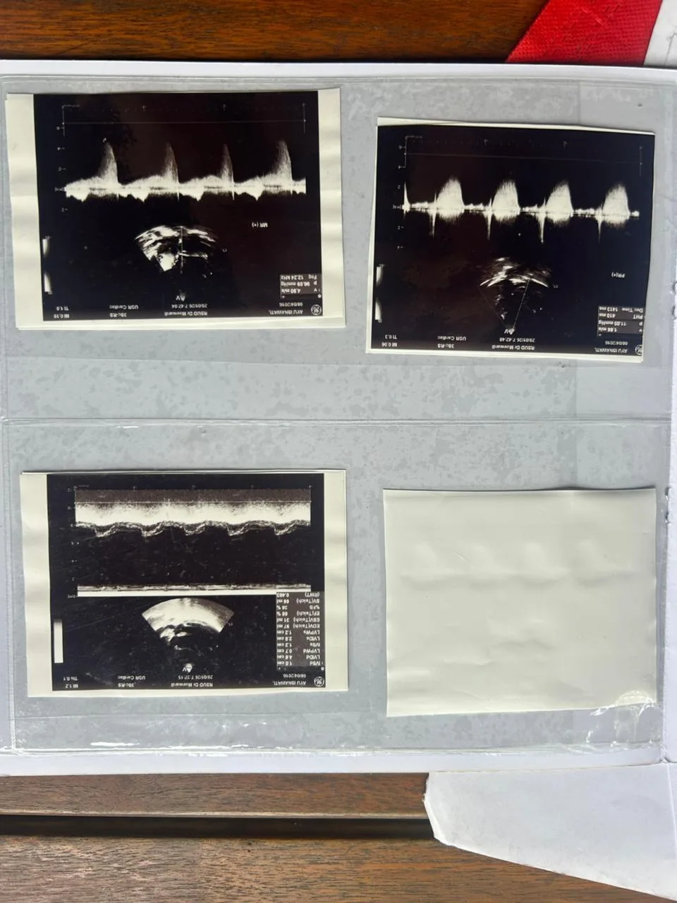 Hasil echocardiography Dek Ayu